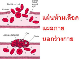 <strong>อ่านเพิ่มเติมเกี่ยวกับ</strong><br>แผ่นห้ามเลือดแผลภายนอกร่างกาย แผ่นห้ามเลือดแผลภายนอกร่างกาย