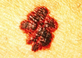 <strong>อ่านเพิ่มเติมเกี่ยวกับ</strong><br>ไฝ บอก "มะเร็งผิวหนัง" ไฝ บอก "มะเร็งผิวหนัง"