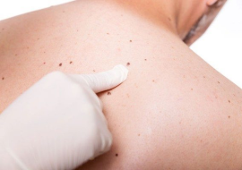 <strong>อ่านเพิ่มเติมเกี่ยวกับ</strong><br>ขี้แมลงวัน เกิดขึ้นได้อย่างไร ขี้แมลงวัน เกิดขึ้นได้อย่างไร