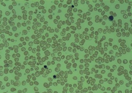 <strong>อ่านเพิ่มเติมเกี่ยวกับ</strong><br>โรคธาลัสซีเมีย โรคธาลัสซีเมีย